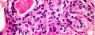 _110580632_c0121365-breast_cancer_cells_lm_-spl.jpg